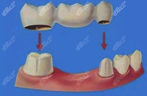通过镶牙修复缺失牙