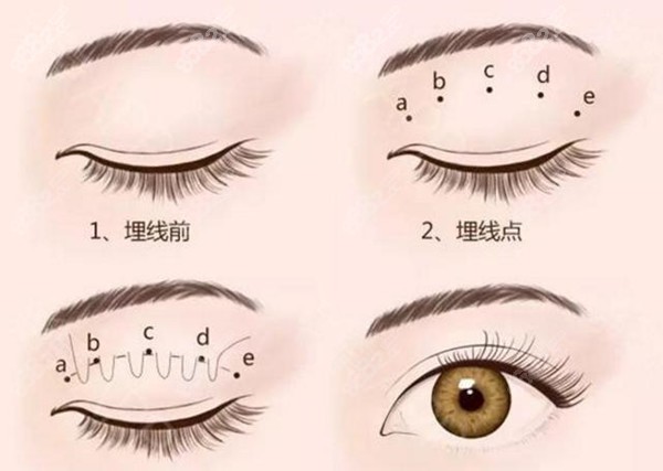 韓國韓系三點雙眼皮價格