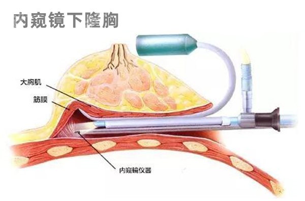 内窥镜隆胸