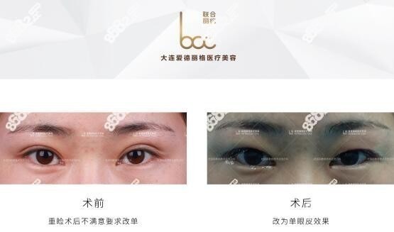 杜园园双眼皮改单眼皮真人<span style=