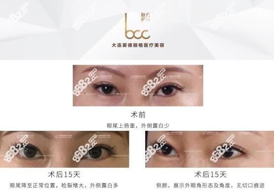 杜园园上睑下垂矫正真人<span style=