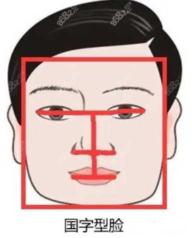 2,长曲线下颌角截骨对正面脸型改变大不大,主要看术前脸型