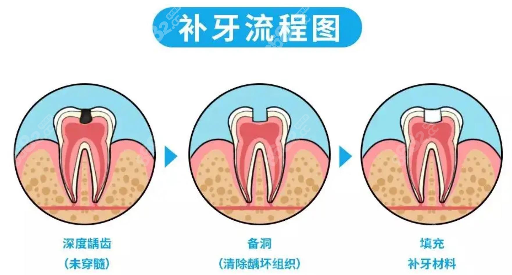 补牙&洗牙注意事项&价格…去过上海多家医院经验分享 - 知乎