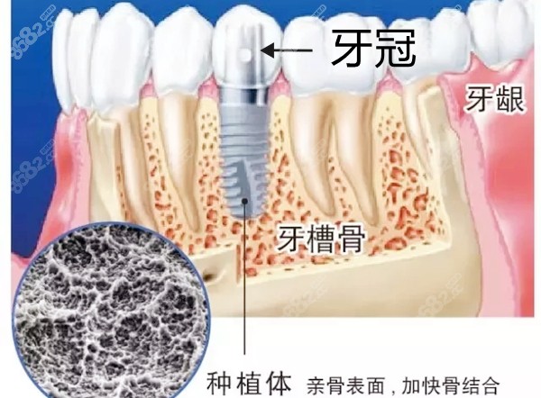 种植牙在牙槽骨内的图