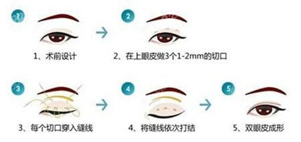 韓國埋線雙眼皮手術價格