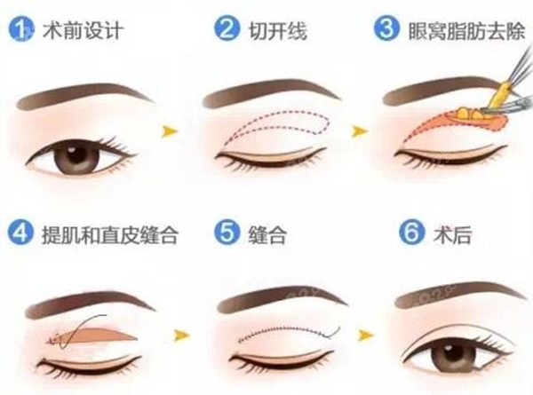 韓國切開雙眼皮多少錢