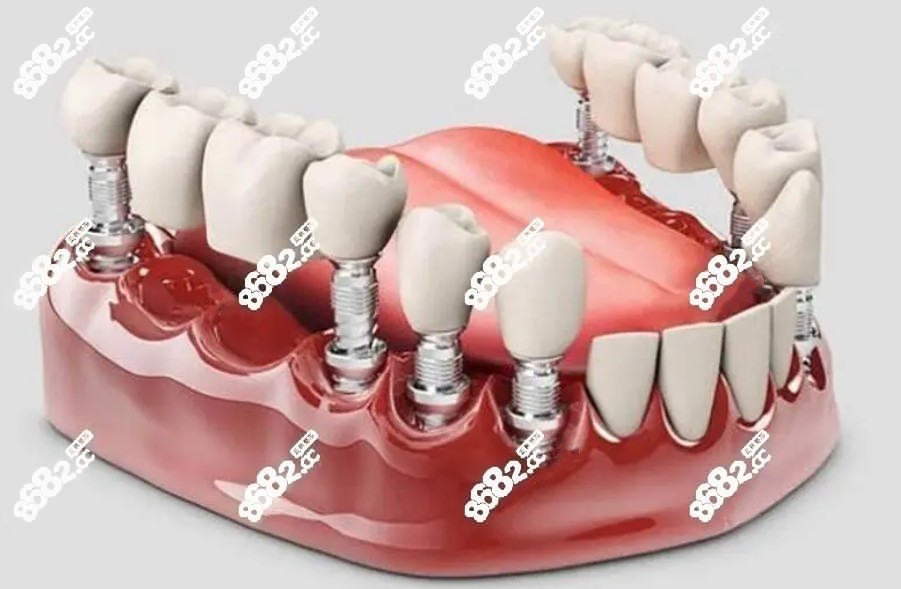 半口牙6个种植体多少钱