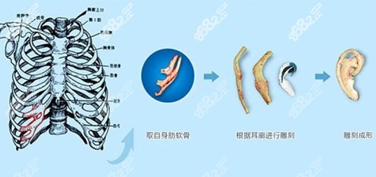 自体肋软骨耳再造的优缺点