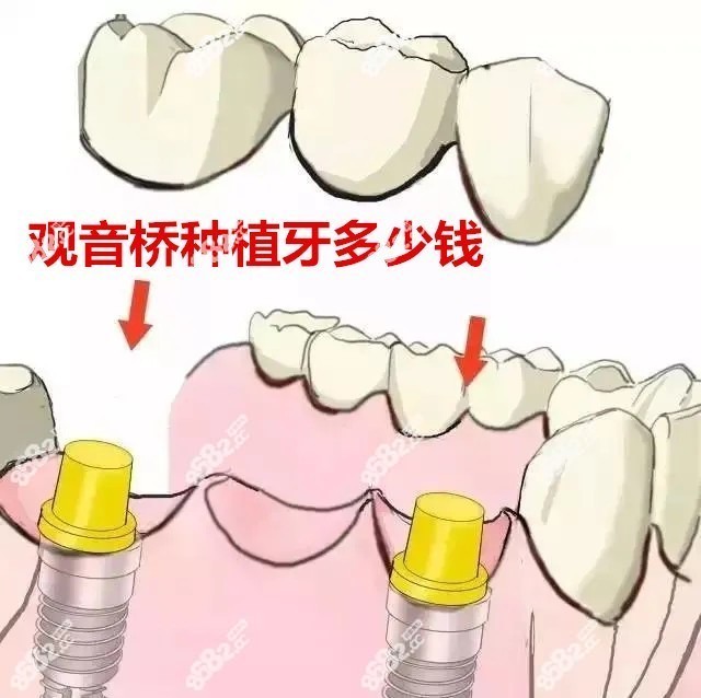 观音桥种植牙多少钱