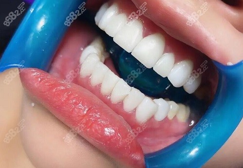 牙齿贴面美白过程