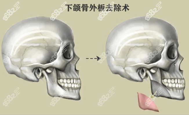 长曲线下颌角截骨劈外板对比图