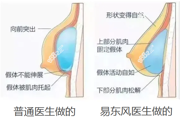 易东风隆胸实例