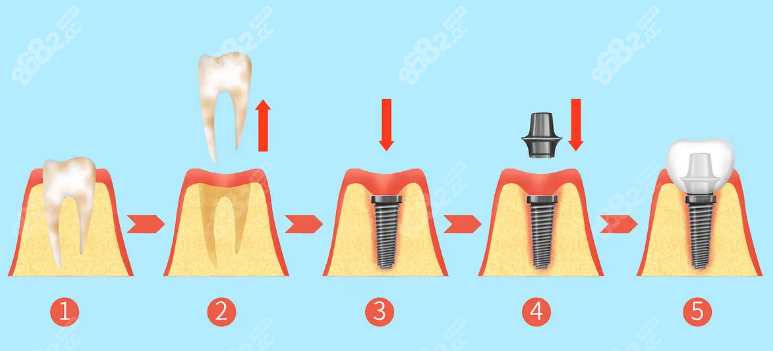 种植牙流程
