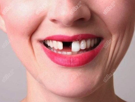 門牙缺失怎么辦？