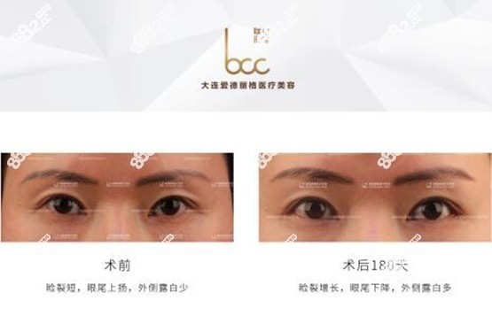 杜园园外眦开大+外眦改型真人<span style=