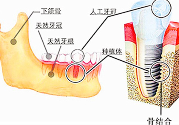 种植牙在牙槽骨内的图