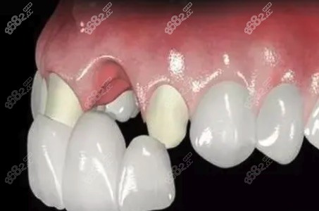 烤瓷牙修復(fù)