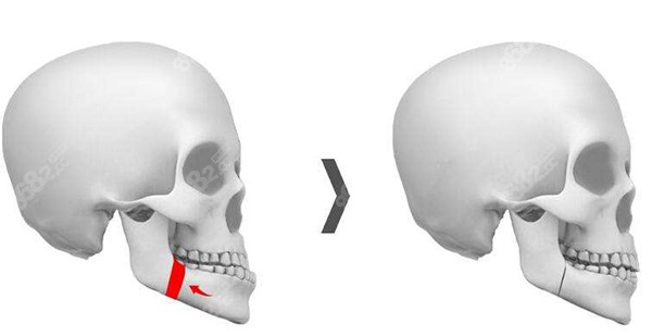 双腭手术和正颌手术的区别