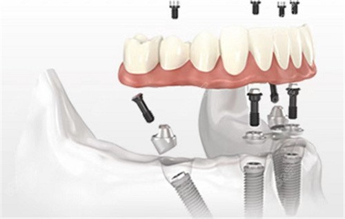中老年人做all-on-4种植牙技术好