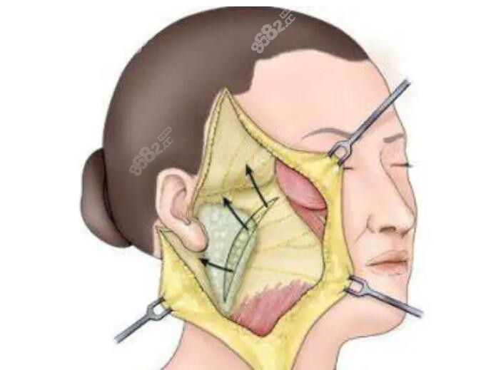 大拉皮手术图片
