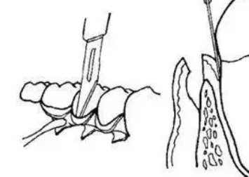 牙冠延长术牙龈切除