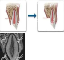 牙短牙冠延长术图解