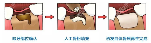 种植牙用骨粉的好处