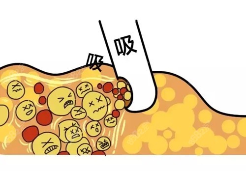 脂肪填充