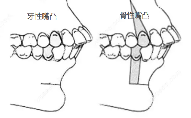 骨性嘴凸和牙性嘴凸对比图