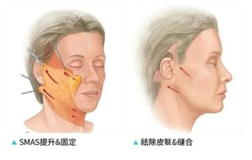 小切口拉皮手术示意图