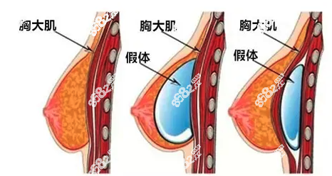 西安十大假体隆胸医院排行榜