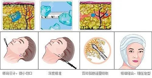 黄金微雕吸脂怎么做的？