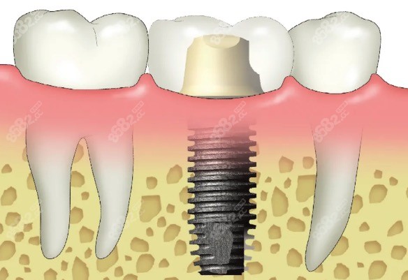 种植牙修复后磨牙