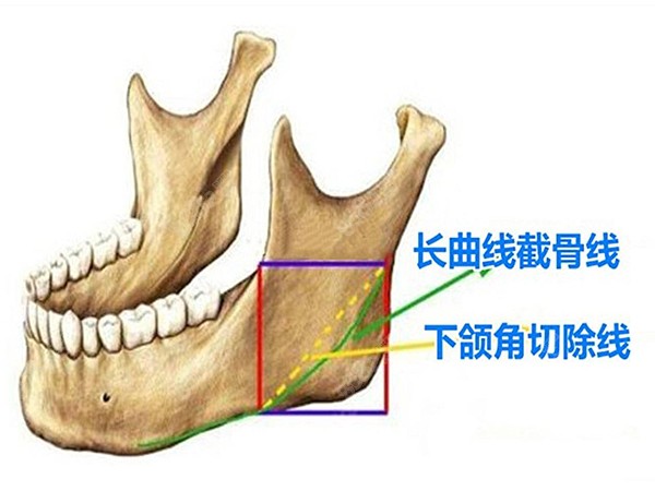 下颌角长曲线截骨术