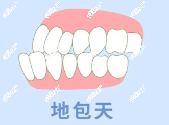 下巴前突（地包天）