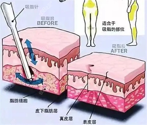 水动力吸脂怎么样？