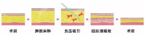 负压吸脂怎么样？