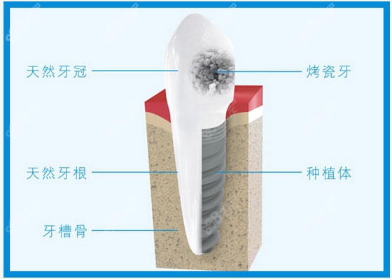 种植牙结构示意图