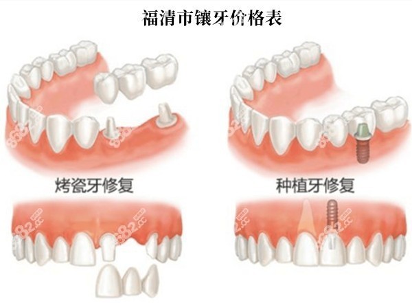 福清镶牙多少钱一颗