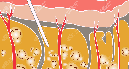 黄金微雕吸脂吸法
