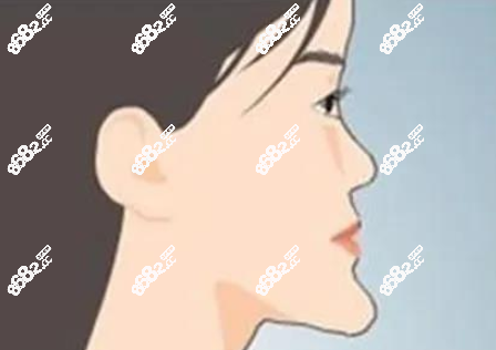 下巴前突矫正有用吗？