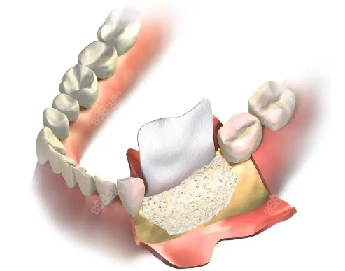 种植牙用骨粉好还是不用骨粉好