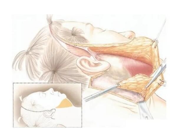 大拉皮和小拉皮手术切口图