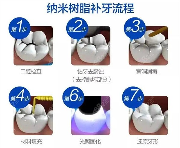 纳米树脂补牙流程