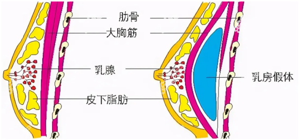 假体隆胸