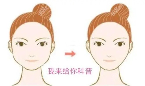 明星为什么不做面部吸脂?