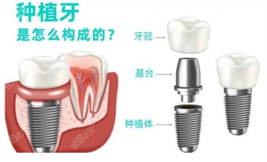 种植牙二期比一期更痛正常吗