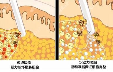 王仁根吸脂