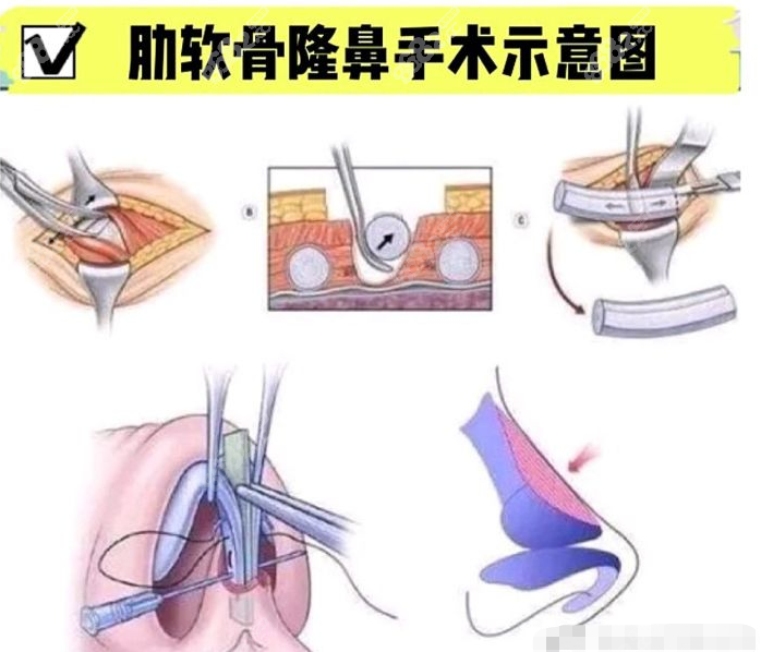 全肋骨鼻贵还是半肋骨鼻贵