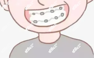 戴金属牙套要注意什么